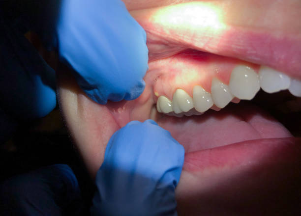 Best Chipped Tooth Repair Near Me  in Oral City, FL